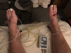 Electroacupuncture and plantar fasciitis
