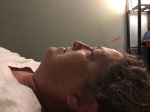 acupuncture for tension headache