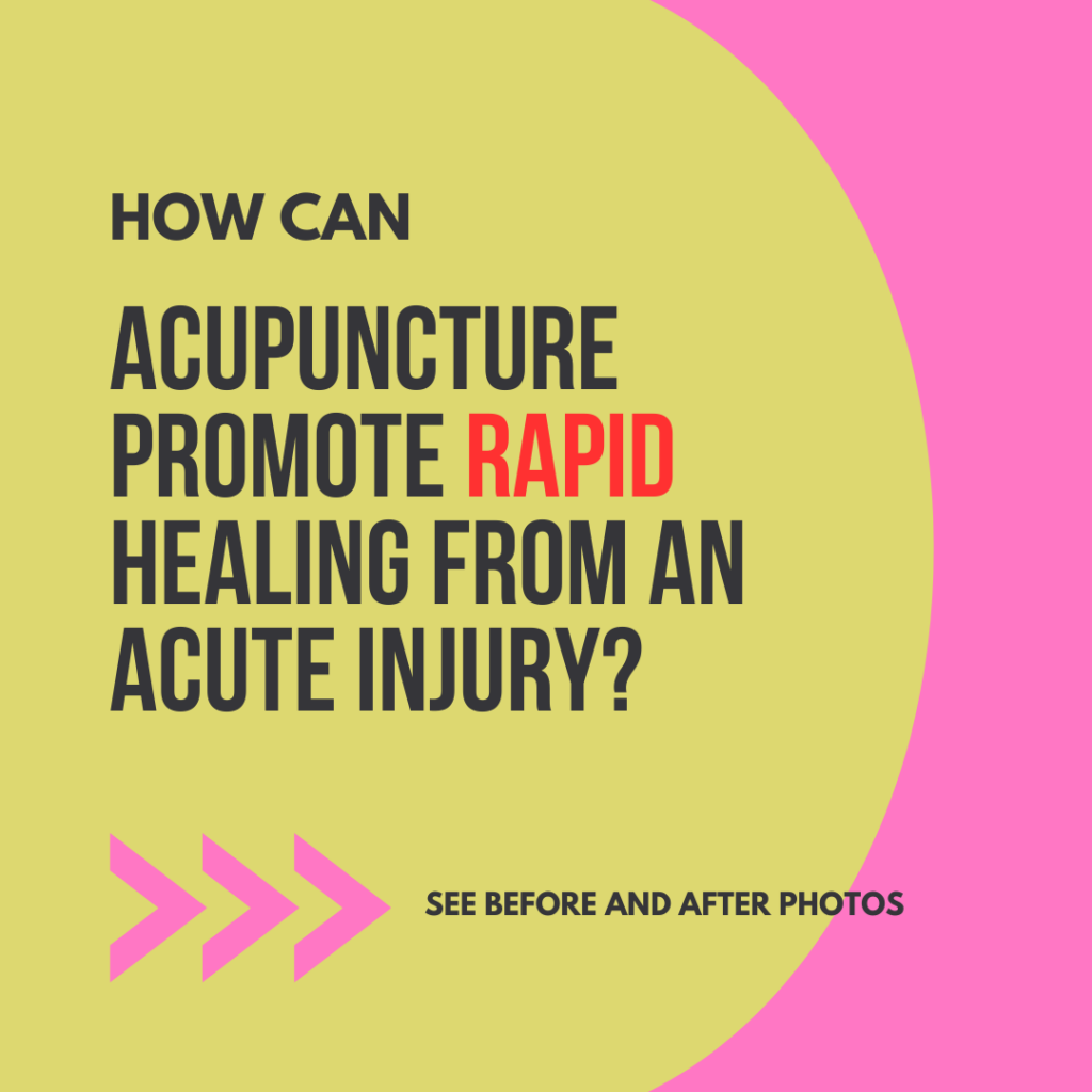 acute injury and acupuncture